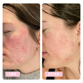 Mariann with rosacea