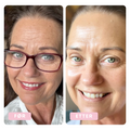June, 54 years old, sun damage