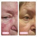 Sunburn, rosacea